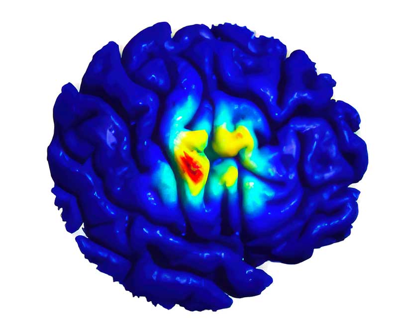 Die Neurostimulation wirkt wie ein intelligenter Taktgeber für das Gehirn – sie gleicht Über- und Unteraktivitäten gezielt aus. Im Bild die Gehirnstimulation durch EASEE. Credits: Precisis GmbH